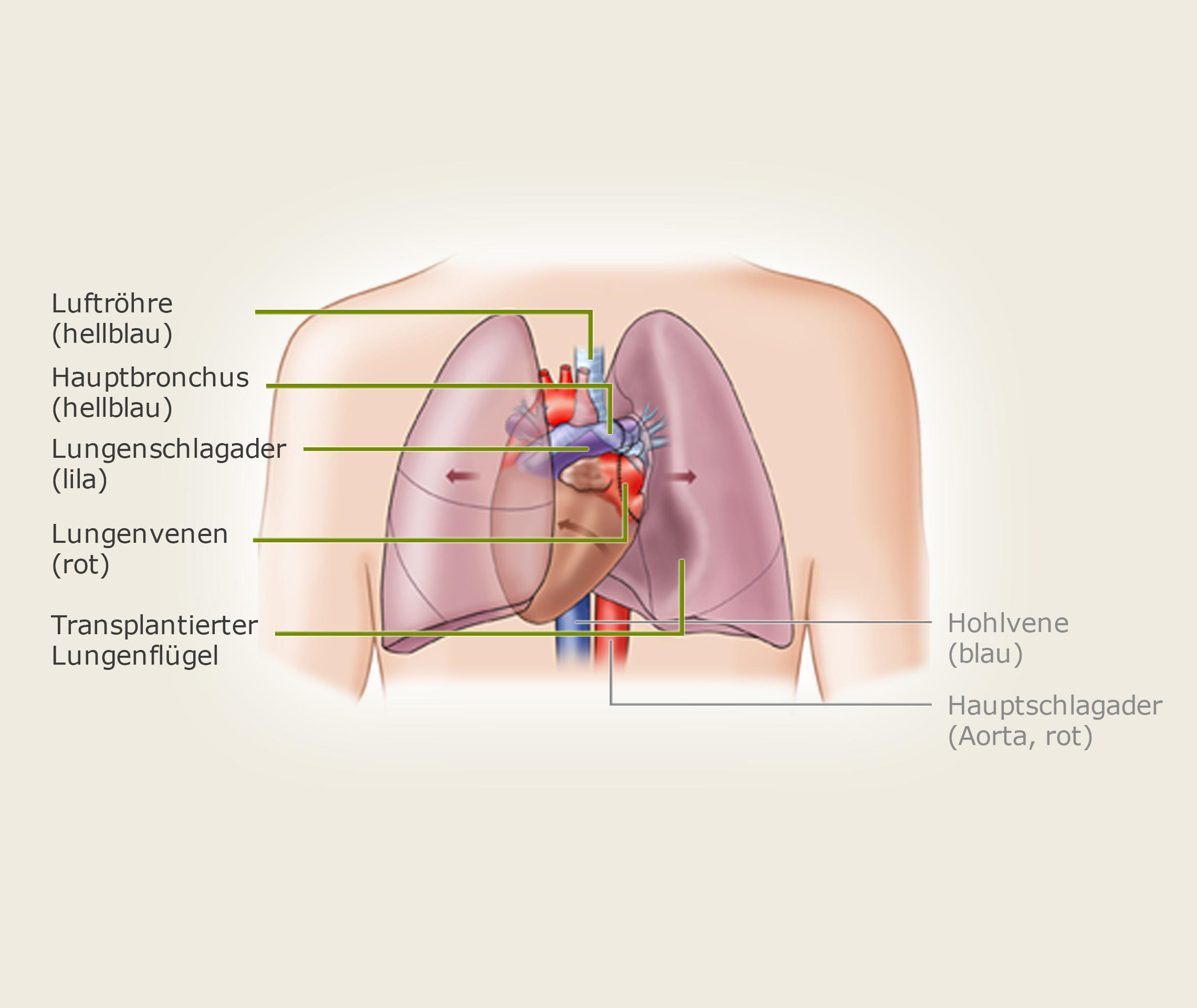 Lungentransplantation-Operation