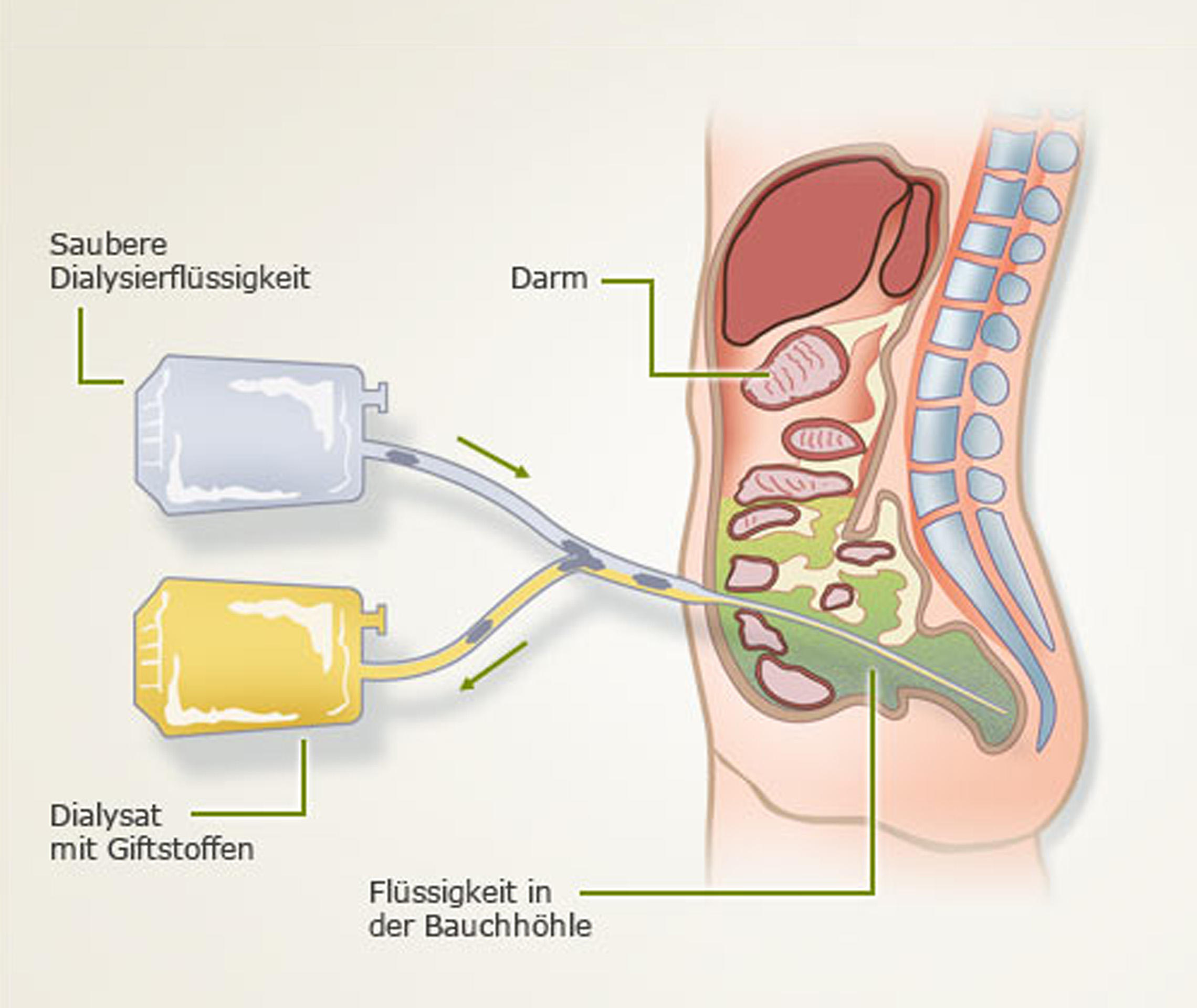 Ablauf einer Peritonealdialyse