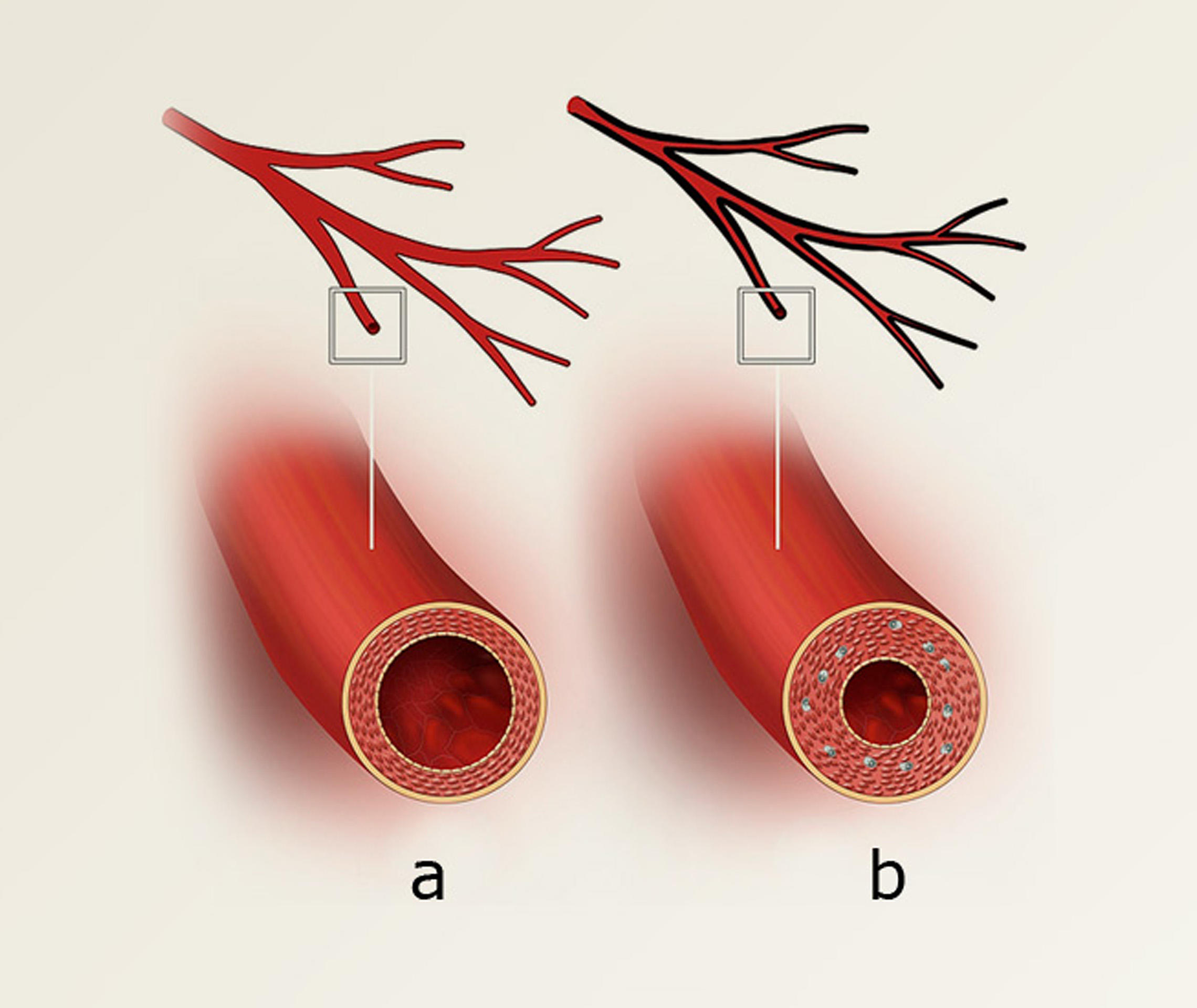 Herzkranzgefäße: (a) normale Arterie (b) Arterie mit verdickter Gefäßwand bei Transplantatvaskulopathie (chronischer Abstoßung) nach Herztransplantation