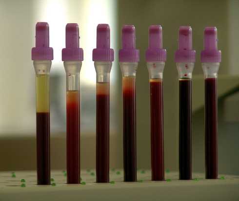 Etappen Operation Postmortale Spende Blutproben