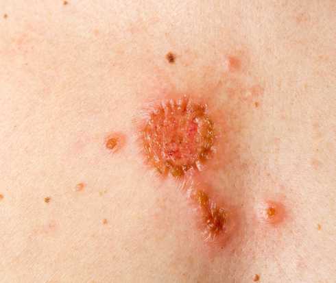 Warum und wie stark ist das Krebsrisiko erhöht?