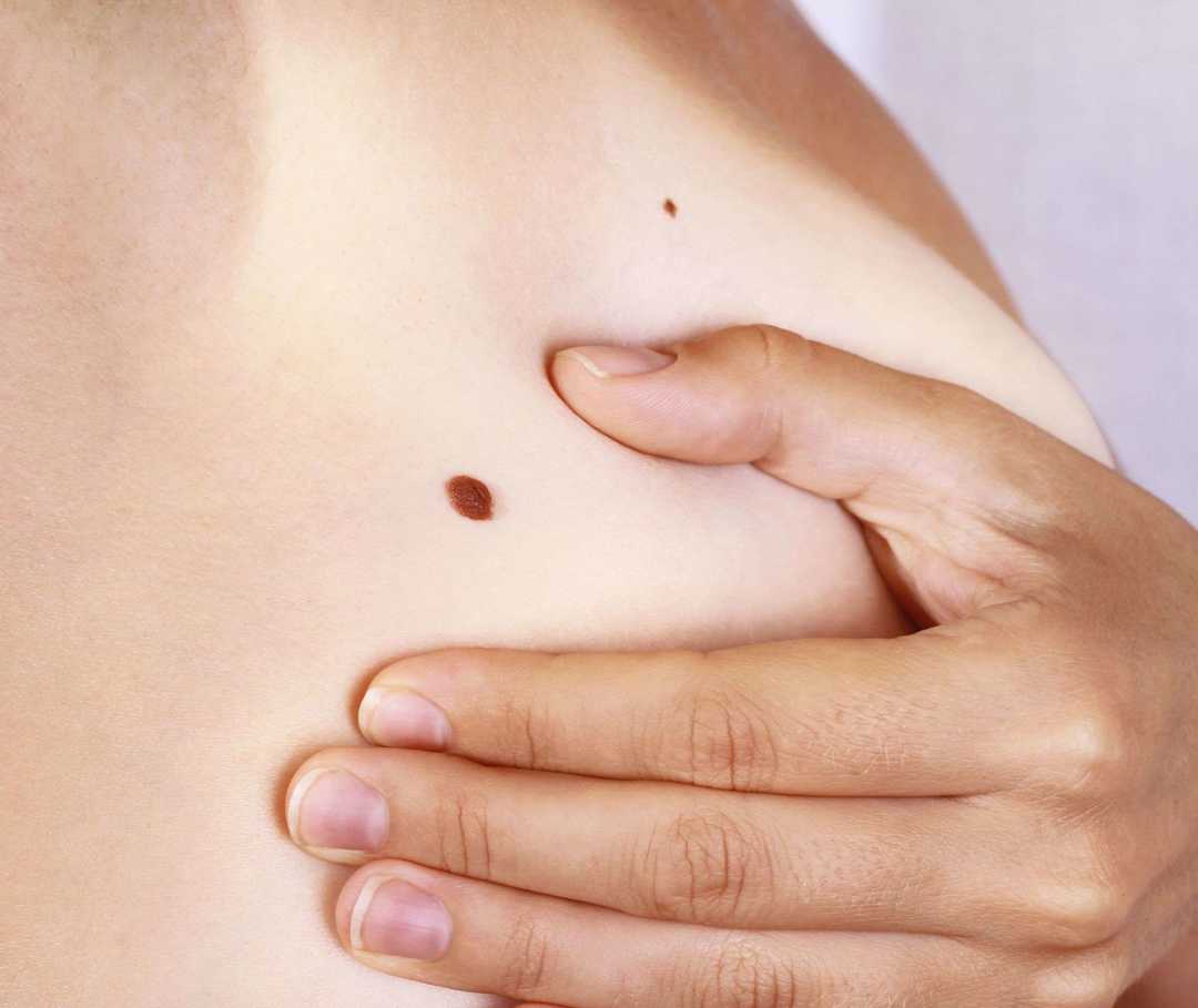 Selbstuntersuchung: Den Hautkrebs früh entdecken