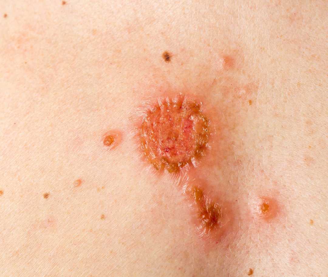 Warum und wie stark ist das Krebsrisiko erhöht?