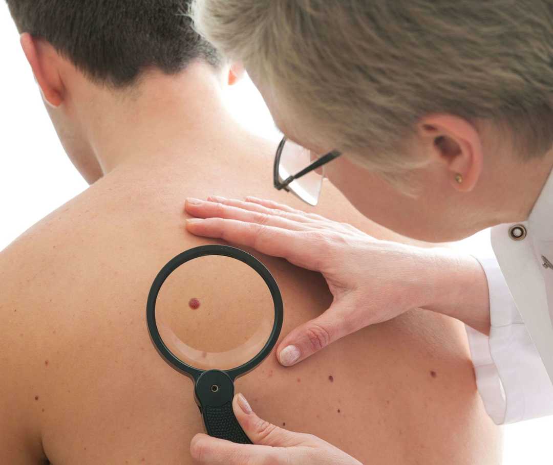 „Weißer Hautkrebs“