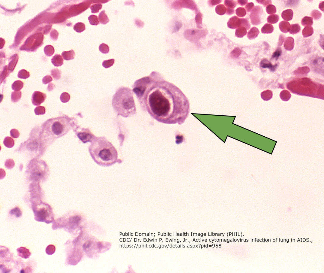 Die markierte Zelle ist mit dem Cytomegalievirus infiziert. (Quelle: CDC/ Dr. Edwin P. Ewing, Jr.)