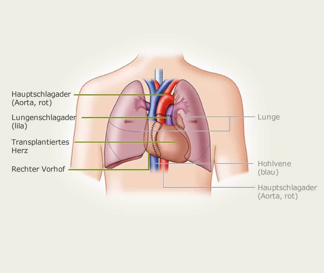 Herztransplantation-Operation