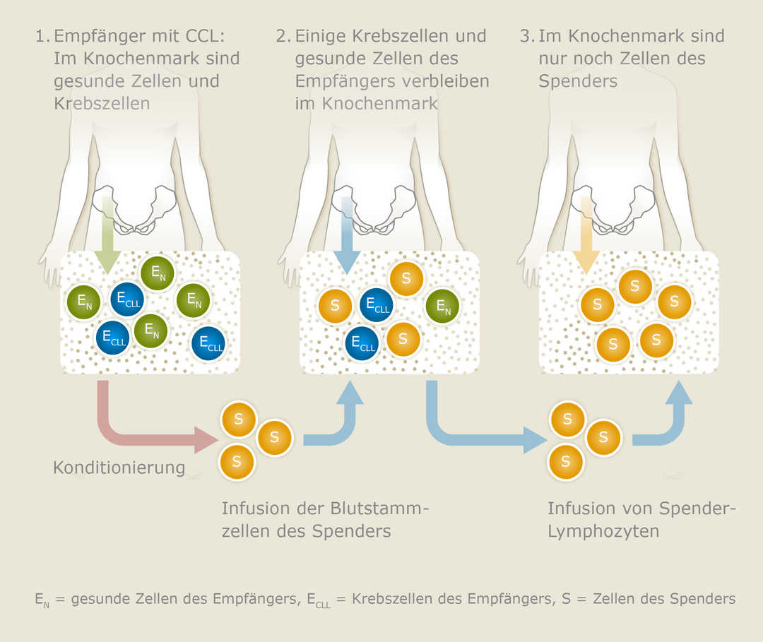 Das Prinzip der nachträglichen Infusion von Spender-Lymphozyten (mod. nach [1])