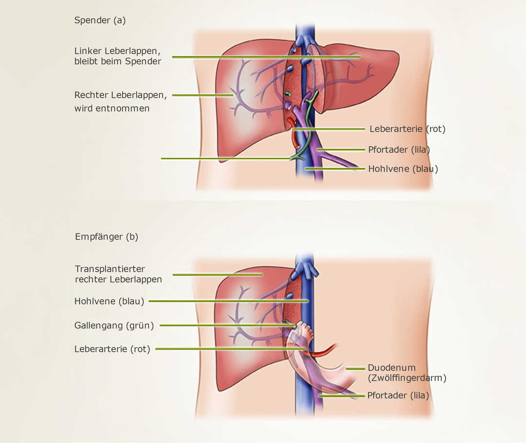 Lebertransplantation-Operation