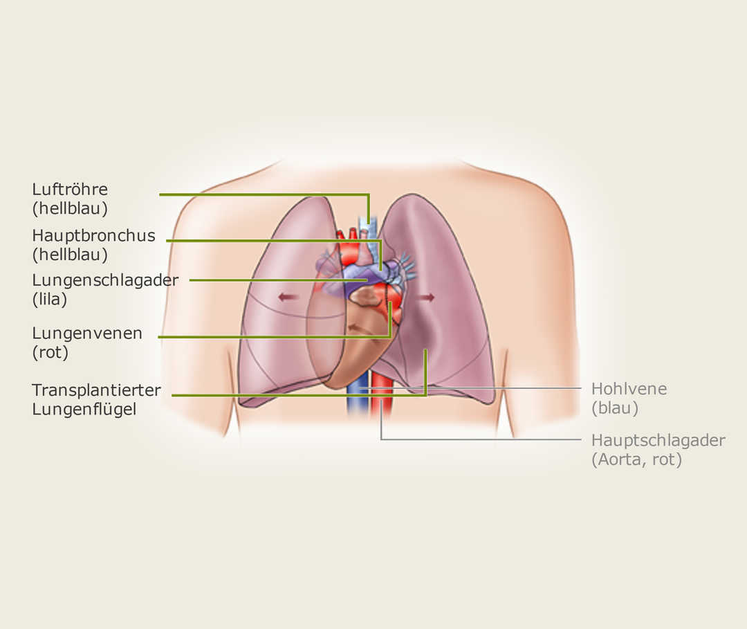 Lungentransplantation-Operation