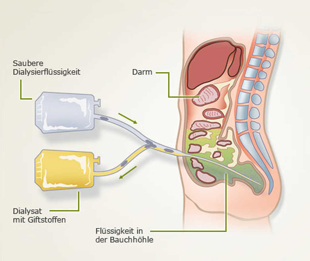 Ablauf einer Peritonealdialyse