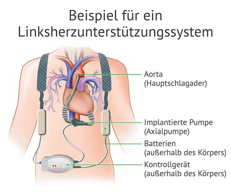 Grafische Darstellung eines Linksherz-Unterstuetzungssystem