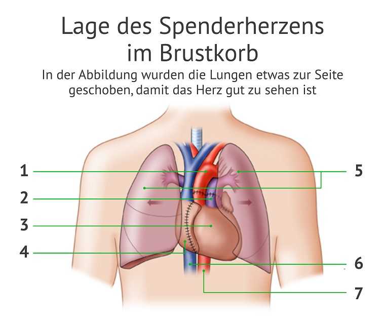 Wie läuft eine Herzoperation ab?
