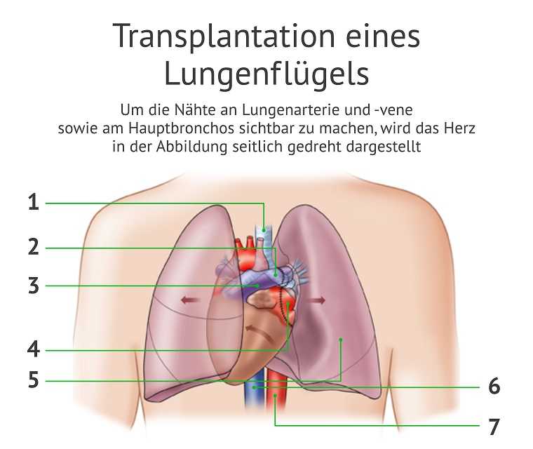 Diese Grafik zeigt die einzelnen Bestandteile der Lunge