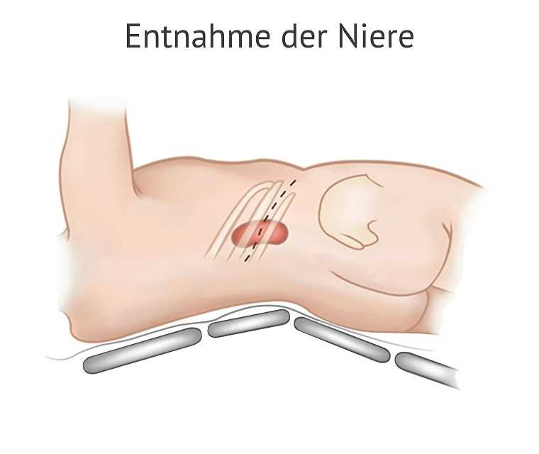 Die Niere wird häufig über einen Schnitt in der Flanke entnommen