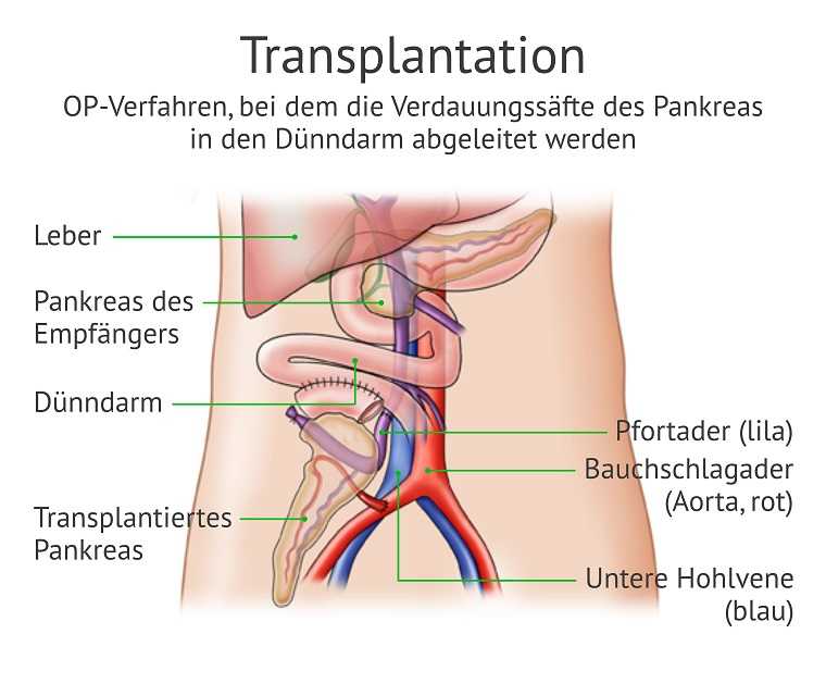 Die Grafik zeigt das OP-Verfahren bei einer Transplantation des Pankreas