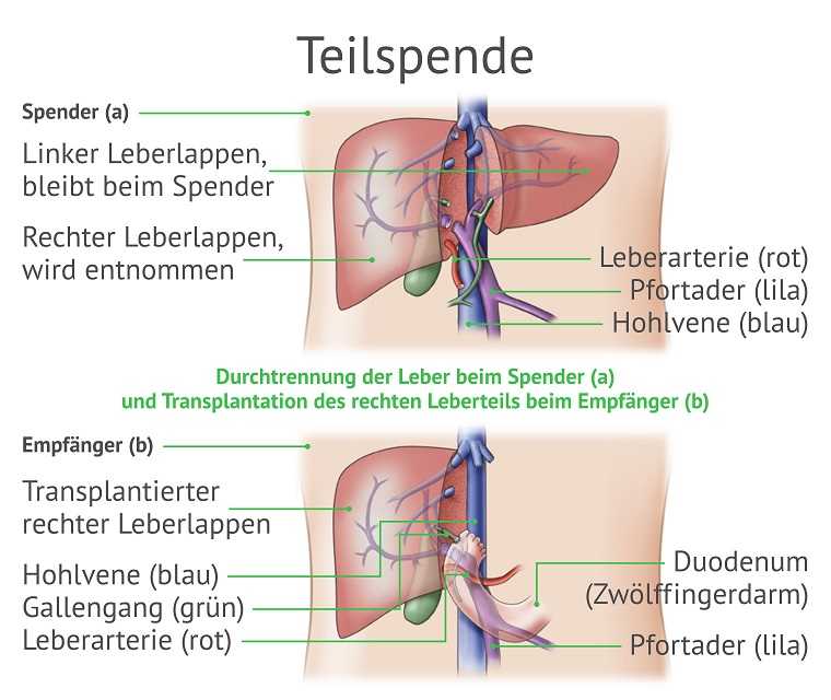 Grafik einer Teilspende der Leber mit Beschriftung der Bestandteile